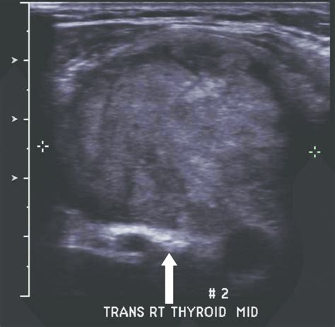 Transverse Sonogram Showing A Large Heterogeneous Right Thyroid Nodule