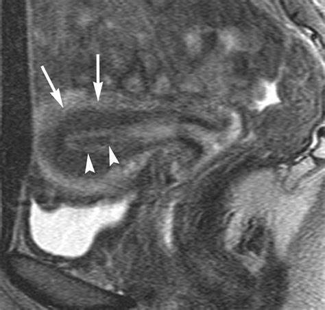 Mr Imaging Findings Of Adenomyosis Correlation With Histopathologic