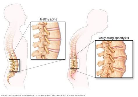 Symptoms Of Spondylitis MEDizzy