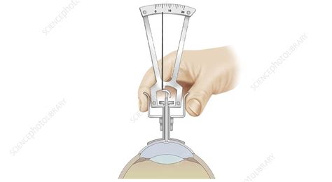 Tonometry, illustration - Stock Image - C046/3007 - Science Photo Library