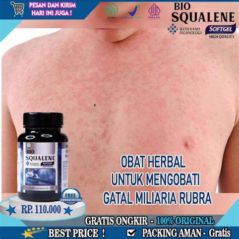 Jual Obat Miliaria Rubra Gatal Biang Keringat Di Leher Anak Dan Dewasa