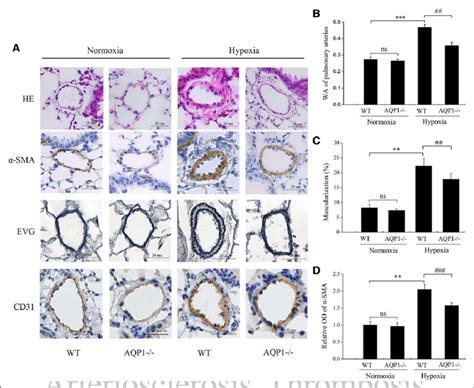 AQP1 Aquaporin 1 Deficiency Attenuates Chronic Hypoxia Induced