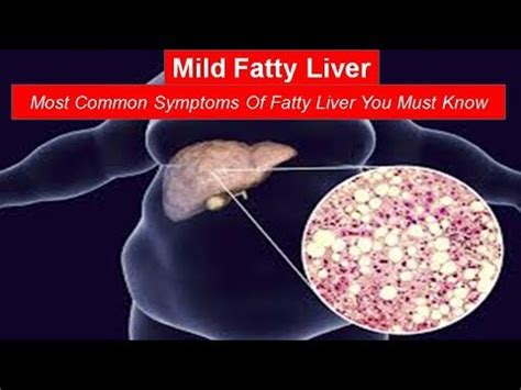 Mild Fatty Liver Most Common Symptoms Of Fatty Liver You Must Know