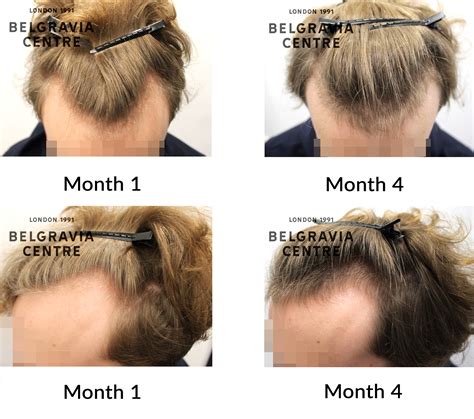 Hair Loss Success Story My Advice Would Be To Take Action Asap As The