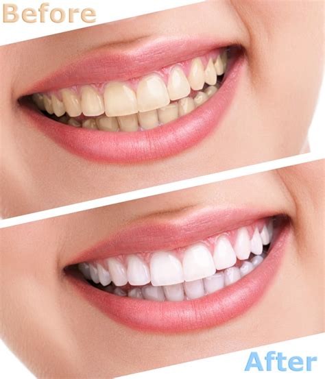 bleaching teeth treatment | Petri Dental