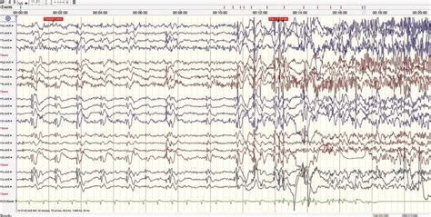 Stuttering Was Followed By A Generalized Seizure With Corresponding