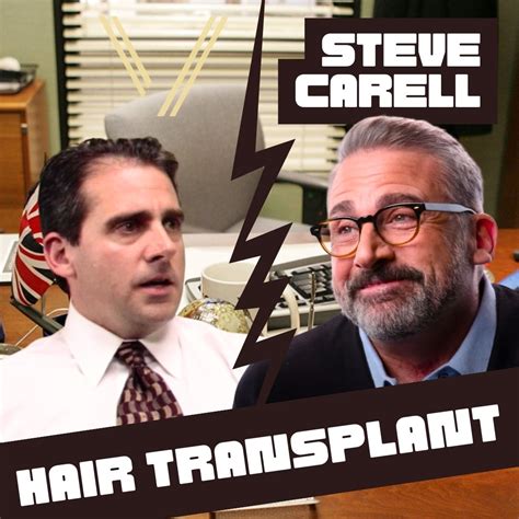 Steve Carell's Hair Transplant: Before and After Transformation