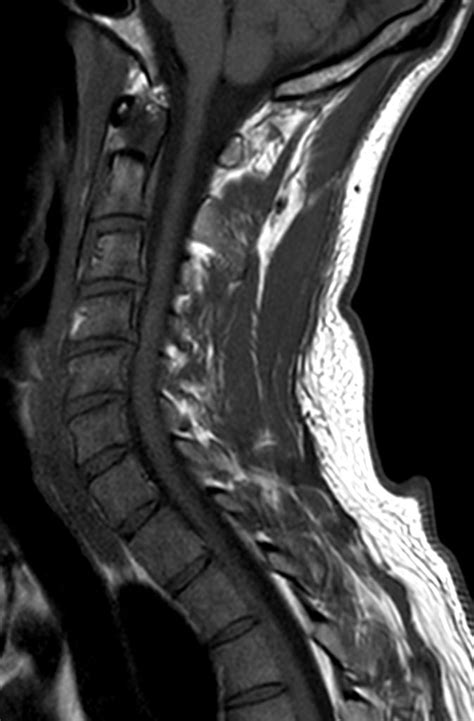 Cervical Spine With Mdixon Xd Philips Mr Body Map