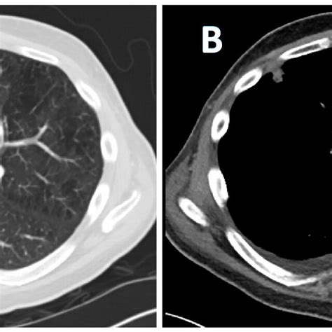 A Lung Window And B Mediastinal Window Of Ct Chest Showing A New