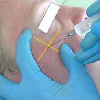 Blockade of the zygomaticofacial nerve (results of our research ...