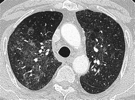 Pneumocystis Carinii Pneumonia Computed Tomography Ct In A Subacute Download Scientific