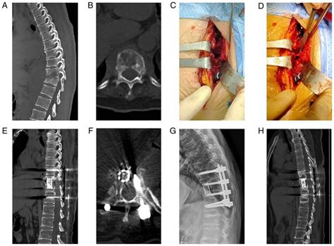 Images Of A 75 Year Old Patient With T9 10 Lesions Who Underwent