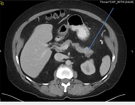 Computed Tomography Ct Scan Of The Abdomen And Pelvis With Download Scientific Diagram