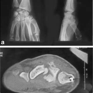 Postero Anterior Lateral And Oblique Radiograph Of Right Wrist Showing