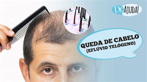 QUEDA DE CABELO EFLÚVIO TELÓGENO O QUE É CAUSAS DIAGNÓSTICO E