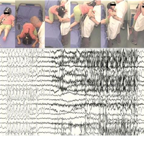 (PDF) Nocturnal Frontal Lobe Epilepsy