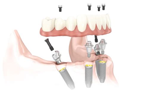 What is Guided Implant Surgery?