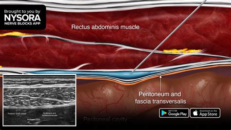 Tips for a Rectus Sheath Block - NYSORA