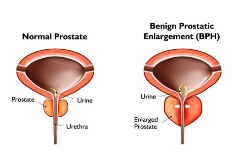 Benign Prostatic Hyperplasia Bph Urology Center Of Iowa