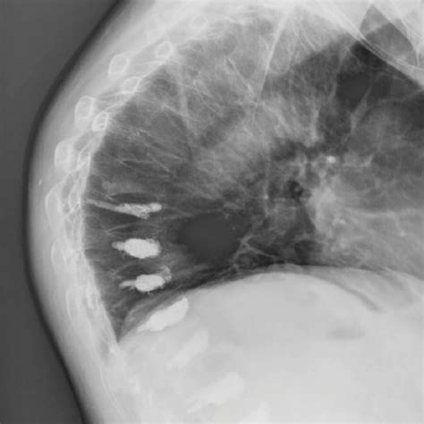 Sternum Fracture X Rays