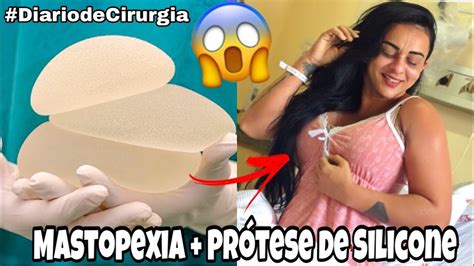 Mastopexia E Pr Tese De Silicone Youtube