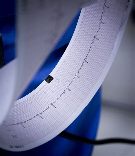 Results Electrocardiogram in Paper Stock Photo - Image of diagnose ...