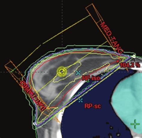 Dosimetric Comparison Of Intensity Modulated Radiotherapy Isocentric