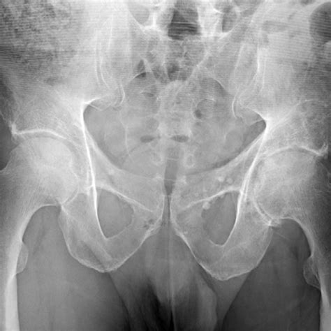 Initial Preoperative Anteroposterior Ap Pelvis Radiograph Download Scientific Diagram