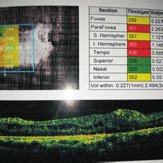 A: Pre-operative OCT of the second patient showing a large macular hole... | Download Scientific ...