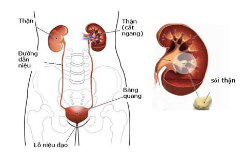 Những điều cần biết về bệnh sỏi thận BvNTP