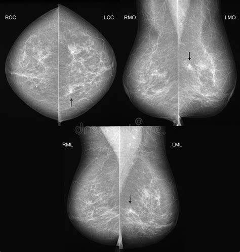 List 98 Images Mammogram Pictures Of Breast Cancer Completed