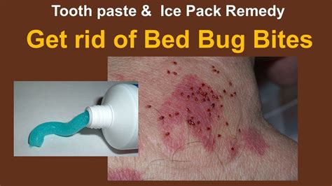 How To Treat Bed Bug Bites On A Baby At Roger Ham Blog