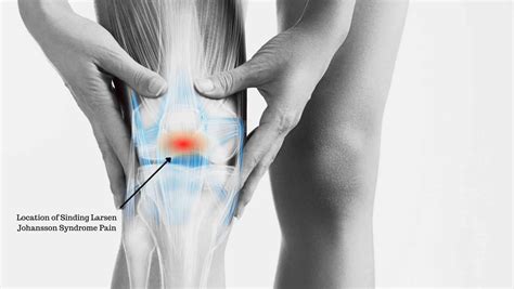 Sinding Larsen Johansson Syndrome Explained By A Specialist