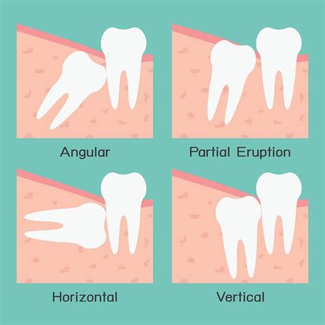 Extracting Wisdom Teeth And Aftercare The Glenroy Dental Group