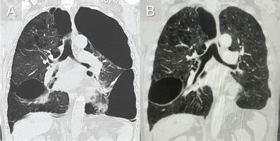 Surgery for pulmonary giant bullae