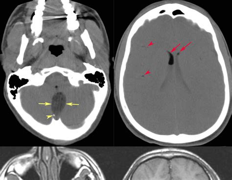 Rit Radiology Ruptured Intracranial Dermoid Cyst