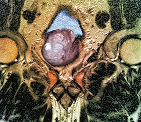 Benign Prostatic Hyperplasia Photograph by Zephyr