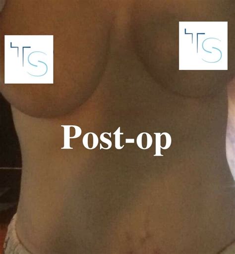 Boob Job Goes Wrong A Mum Of Four S Horror Story