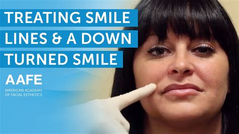 Treating Smile Lines And A Downturned Smile Aafe Youtube