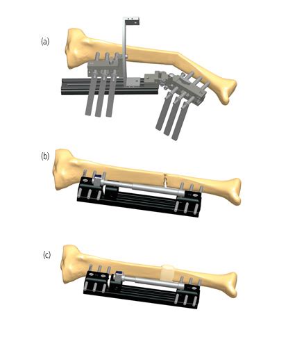 Correction Of Tibial Deformity With Lengthening Orthofix ABS