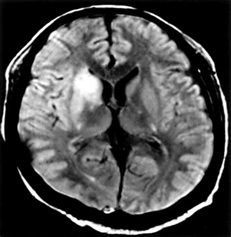 Caudate Nucleus Mri