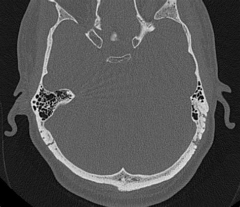 File:Petrous bone trauma - fracture, ossicular dislocation and ...