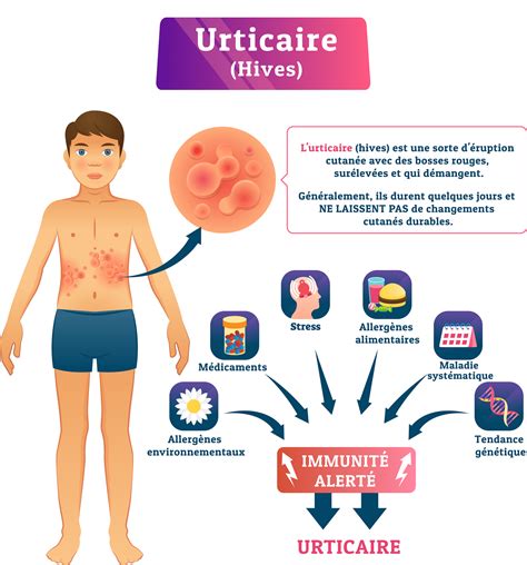 Urticaire Causes Symptômes et Traitements Information hospitalière