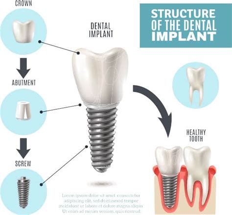 Dental Implants Beverly Hills Tooth Implant Expert