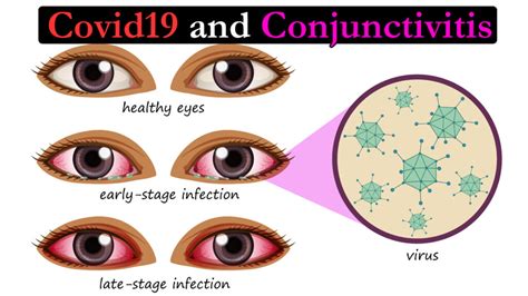 Covid19 and Conjunctivitis - Health Vision