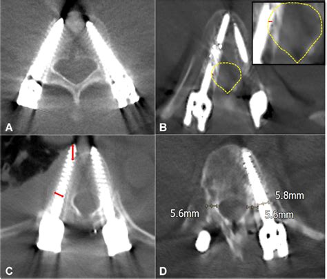 Ct Image Evaluation For Pedicle Screw Breach A Gertzbein Robbins Download Scientific Diagram