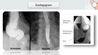 Aksi Achalasia Esofagus Ppt