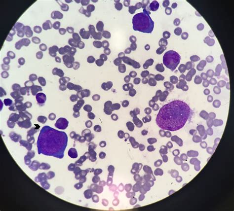 Pure Red Cell Aplasia And Hiv Infection What To Suspect Bmj Case