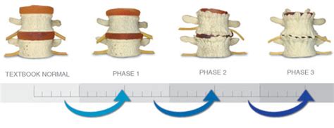 Phases of Degeneration - Porterfield Family Chiropractic