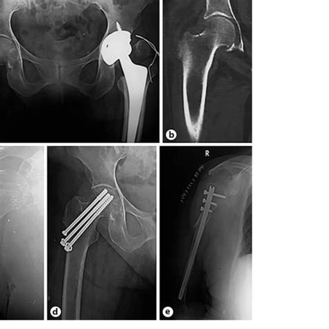 A Right Subtrochanteric Fracture Of The Femur Distal To The Last